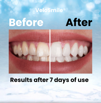 VeloSmile™ LED Whitening Kit